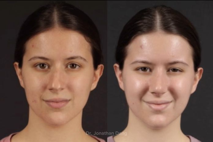 Rhinoplasty 5