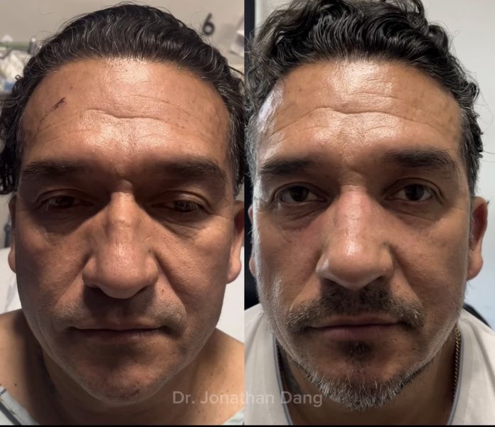 Rhinoplasty 7