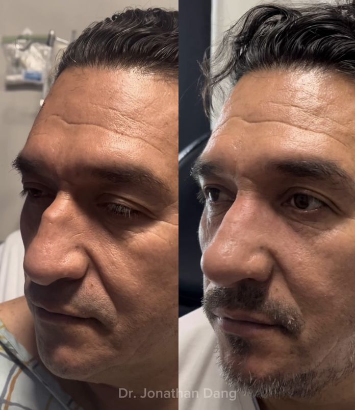 Rhinoplasty 8