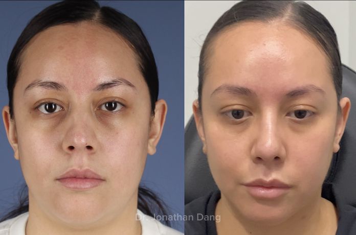 Rhinoplasty 9