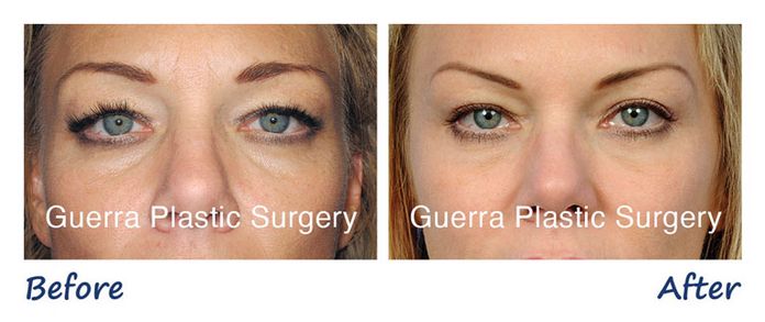 Before and After photo of actual patient - Eyelid Surgery