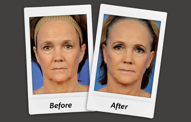 Before and after photo of actual patient - Facelift