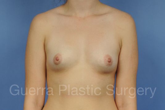 Case #1002165 Before
