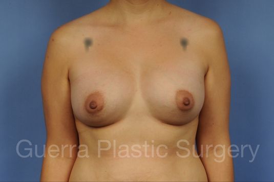 Case #1002160 After