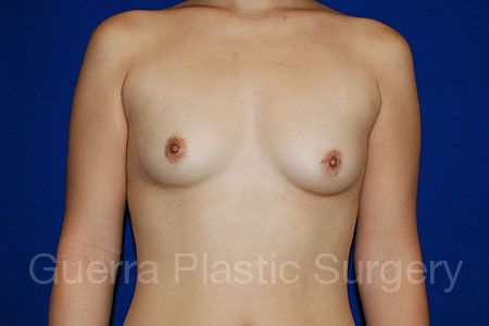 Case #31847 Before