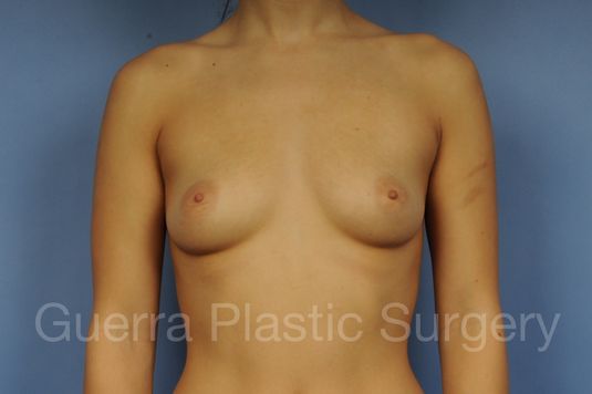 next Case #1002170 Before