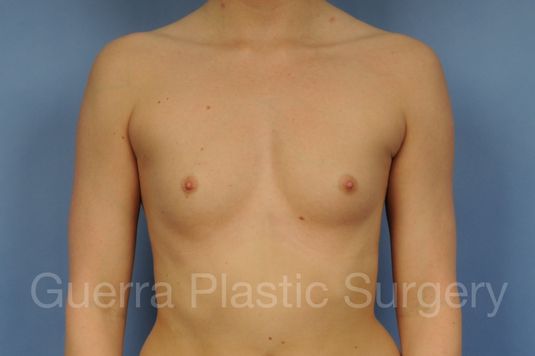 Case #21282 Before