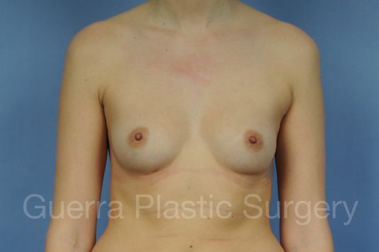 Case #21426 Before