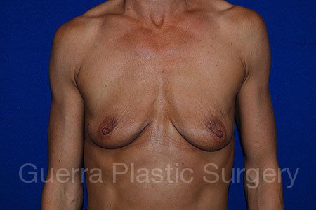 Case #25903 Before