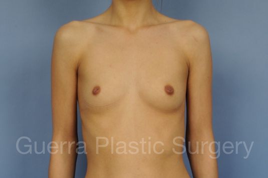 Case #22077 Before