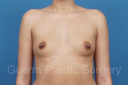 Case #29290 Before
