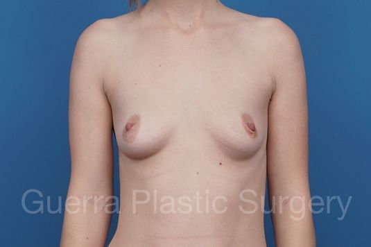 Case #29091 Before