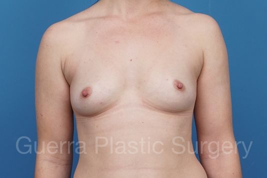 Case #29190 Before