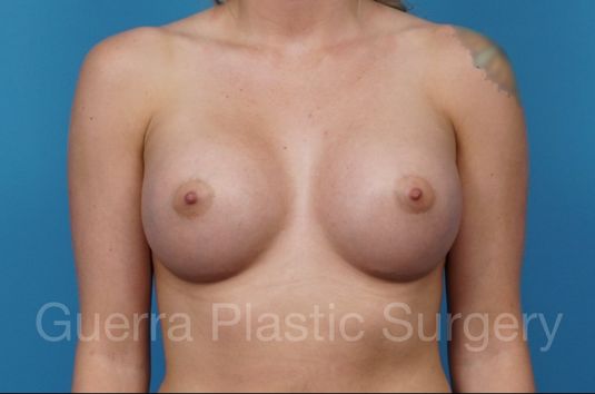 next Case #35963 After