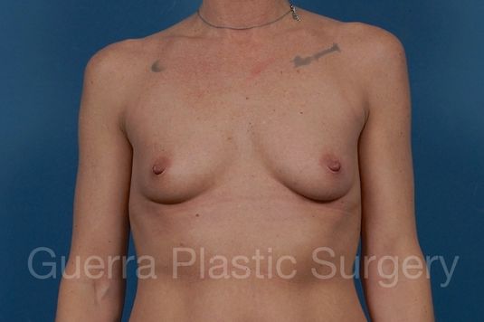 Case #36605 Before