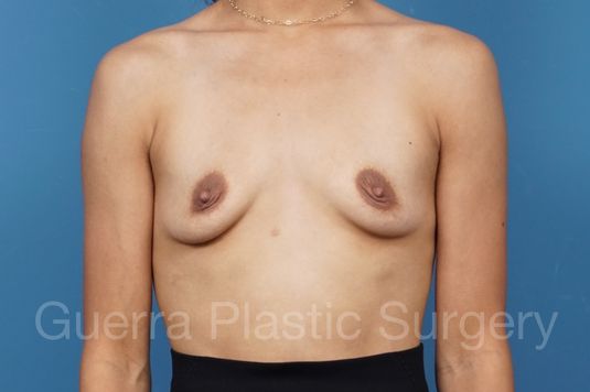 Case #35305 Before