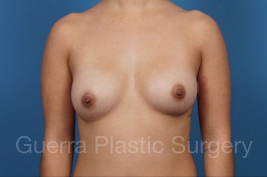 Case #36716 Before