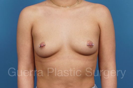 Case #35090 Before