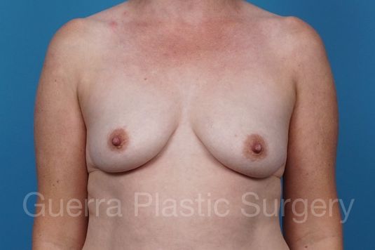 Case #37404 Before