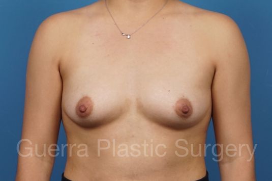 Case #35401 Before