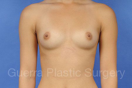 Case #30993 Before