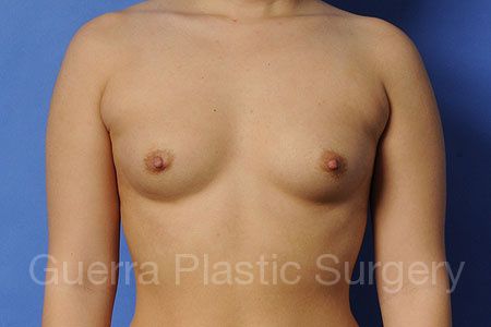 Case #37231 Before