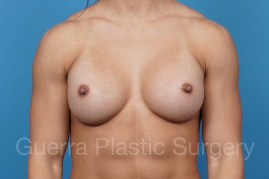 prev Case #38801 After