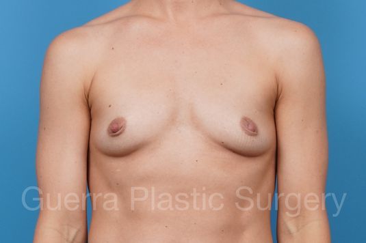 Case #38438 Before