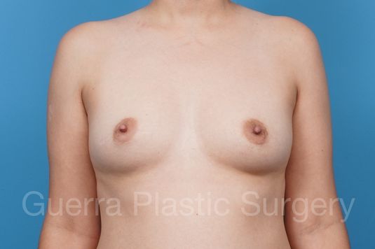 Before Photo Breast Augmentation