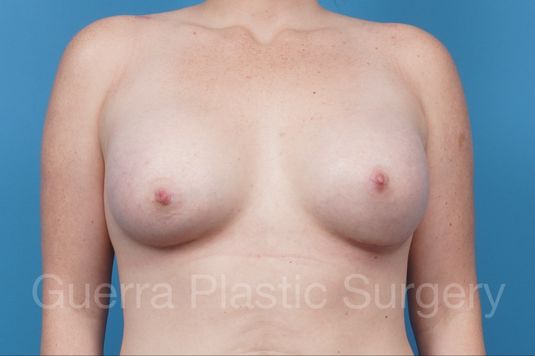 prev Case #38888 After