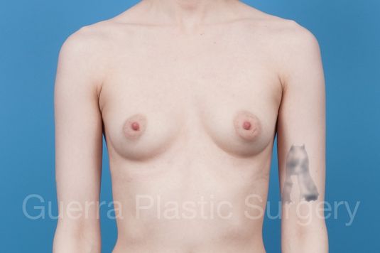 prev Case #39688 Before