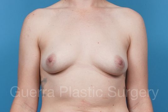 next Case #41483 Before