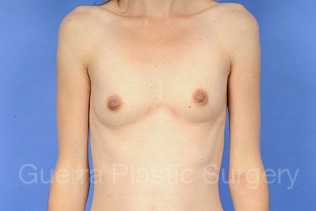 Case #31534 Before
