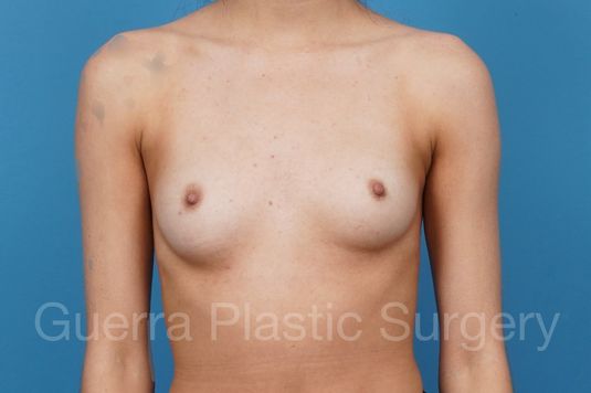 next Case #43313 Before