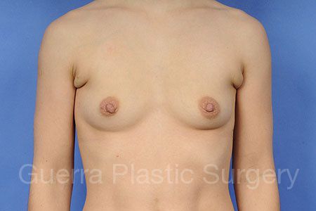 Case #77665 Before