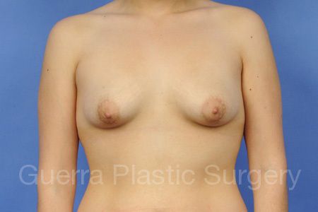 Case #25879 Before