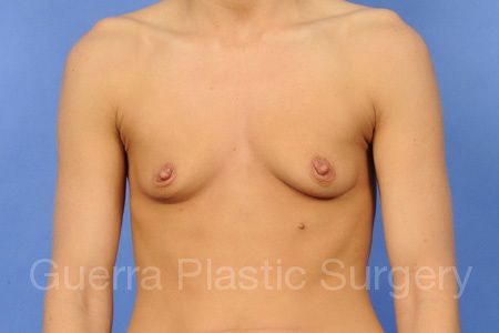 Case #45983 Before
