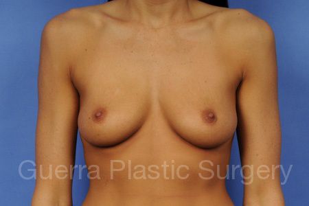 Case #65896 Before
