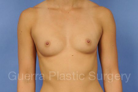 Case #36524 Before