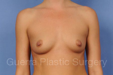 Case #75986 Before