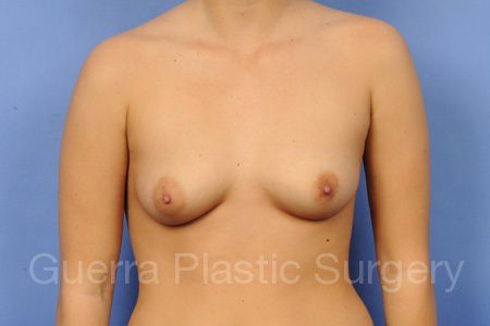 Case #37123 Before