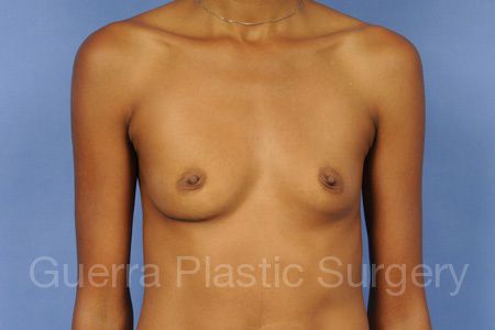 Case #13126 Before