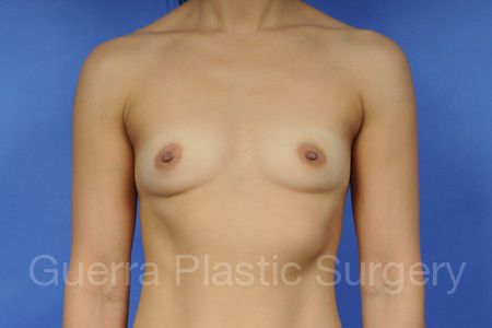 Case #51497 Before