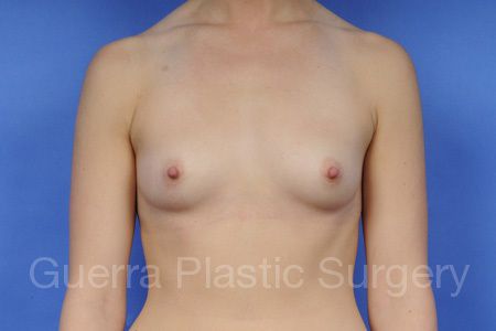Case #58799 Before