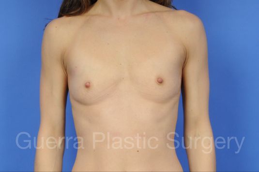 Case #15136 Before