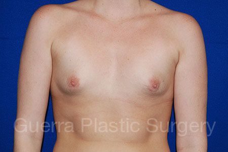 Case #10023 Before