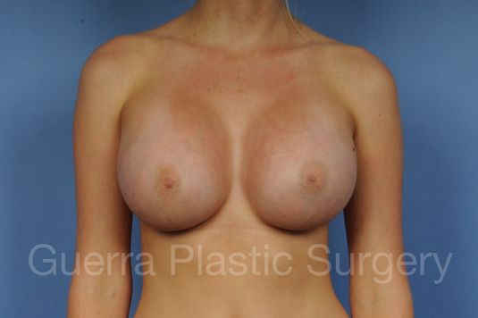 next Case #1003015 After