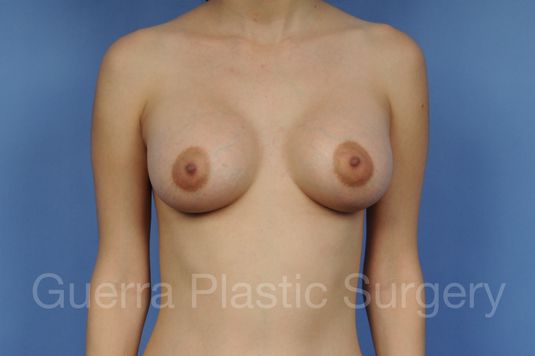 prev Case #1003017 After