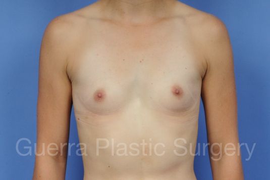 Case #1001106 Before