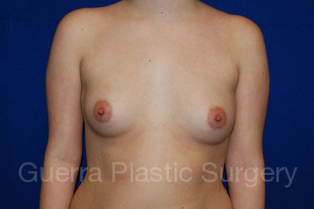 Case #28503 Before